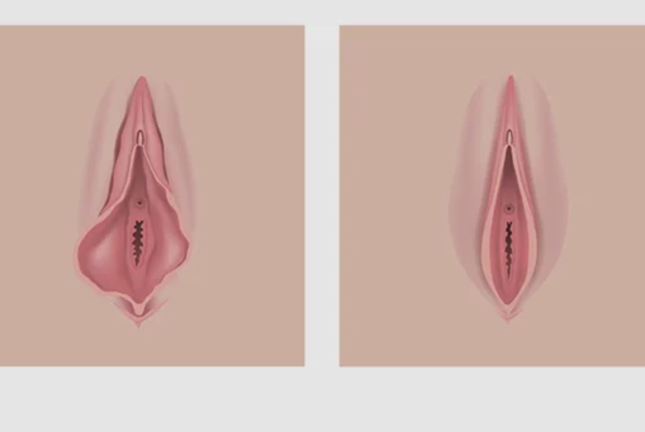 Can Too Much Sex Loosen the Vagina?