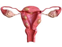 How to Manage Pain and Discomfort While Living With Uterine Fibroids