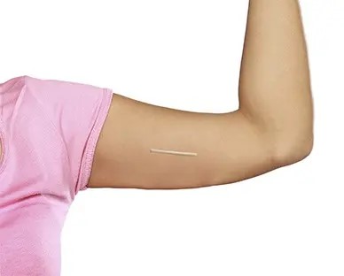 Everything to Know About the Contraceptive Implant (‘the rod’)