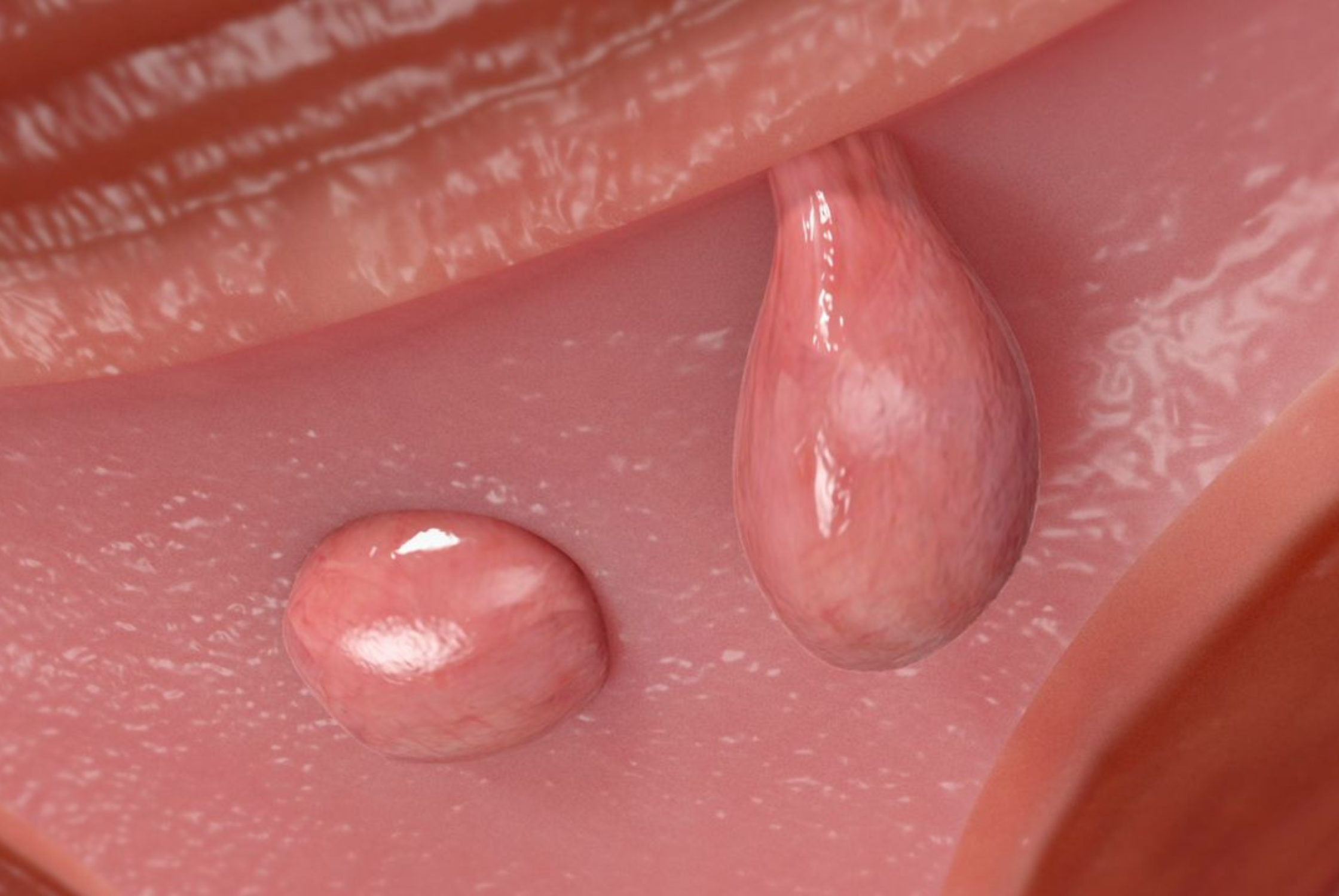 What Are Uterine Polyps? Causes, Symptoms, Diagnosis, and Treatment