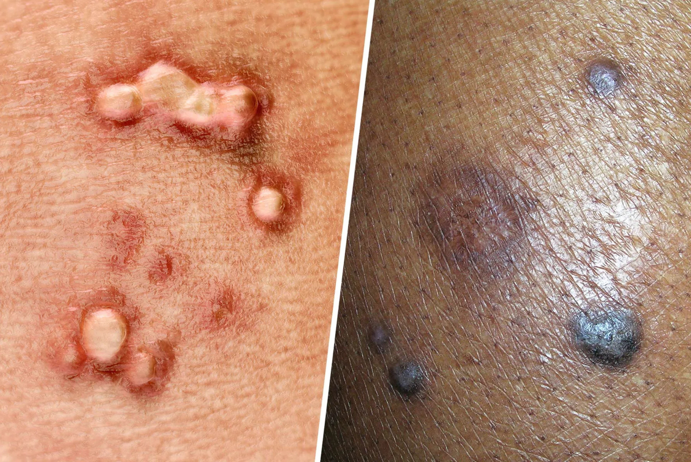What Really Is HPV?