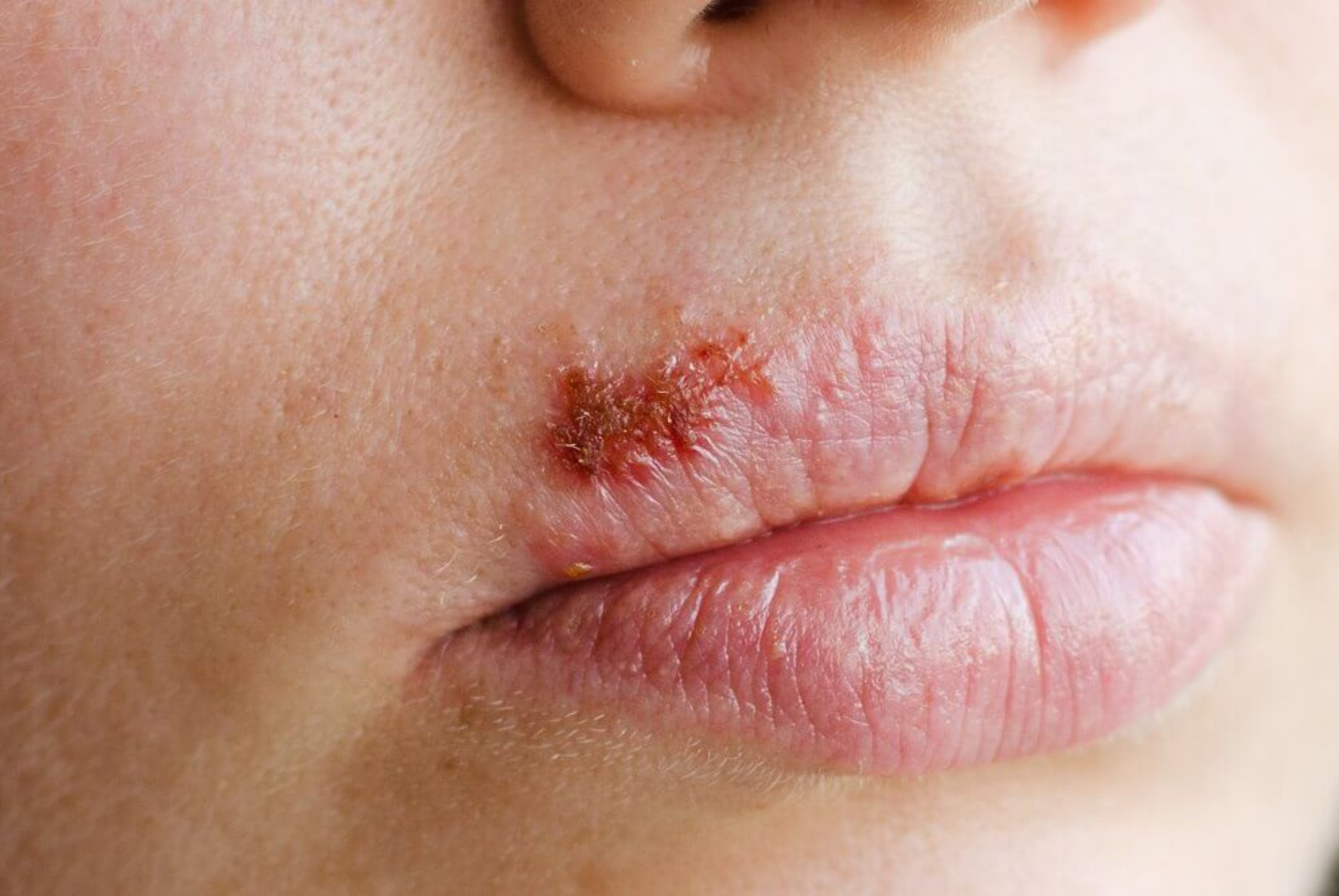 An Overview of Symptoms, Causes, and Treatment of Herpes