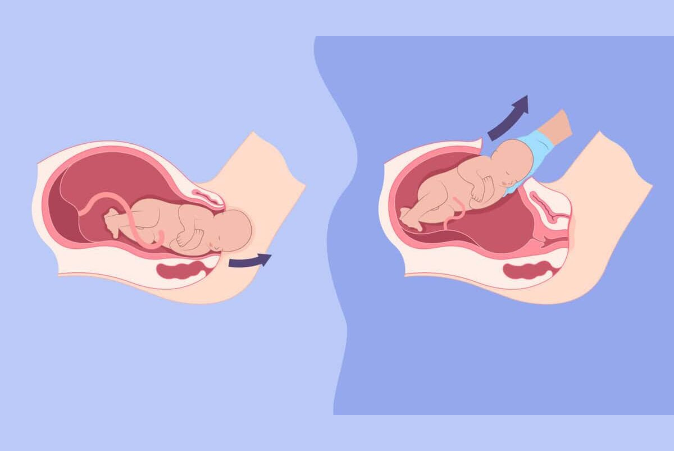 Are C-Sections Easier Than Vaginal Births?