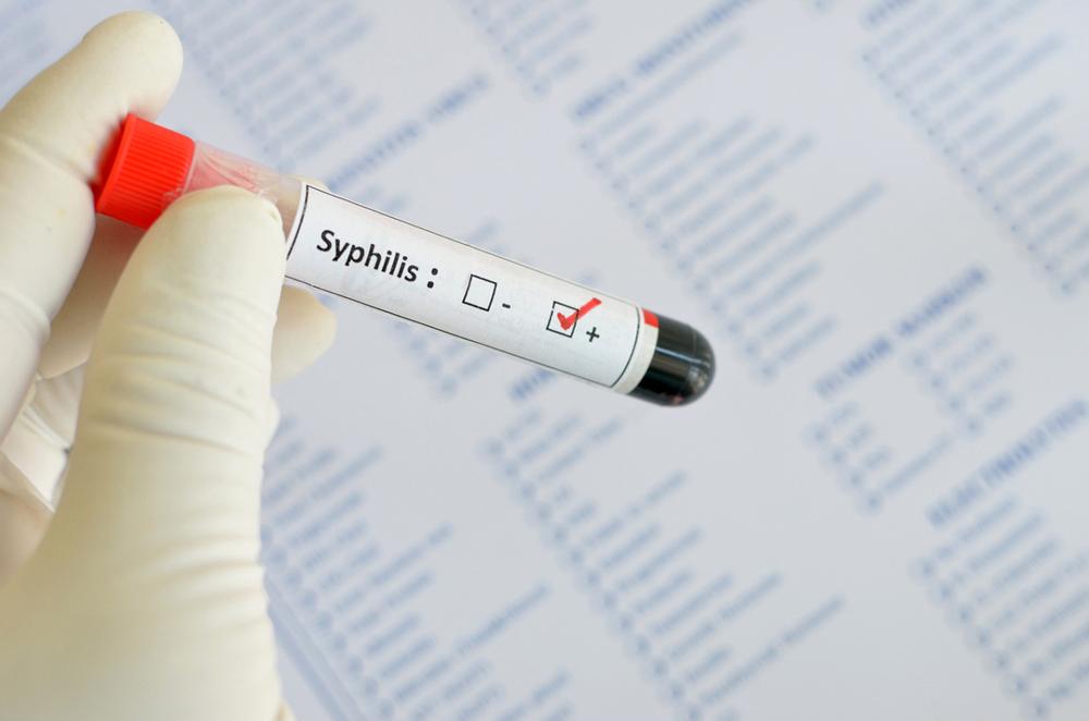 Everything You Should Know About Syphilis