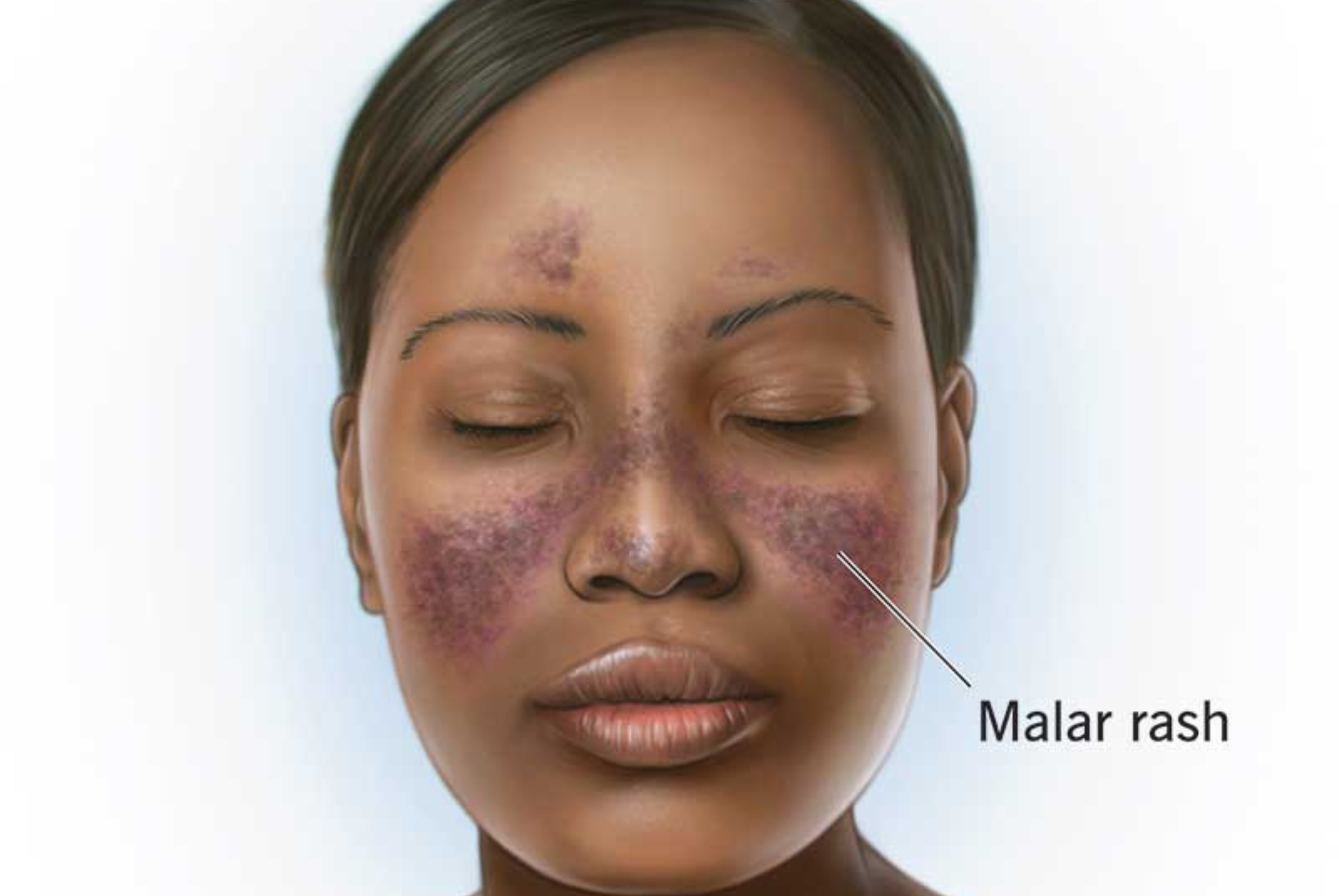 What’s the Connection Between Lupus and Women’s Health?