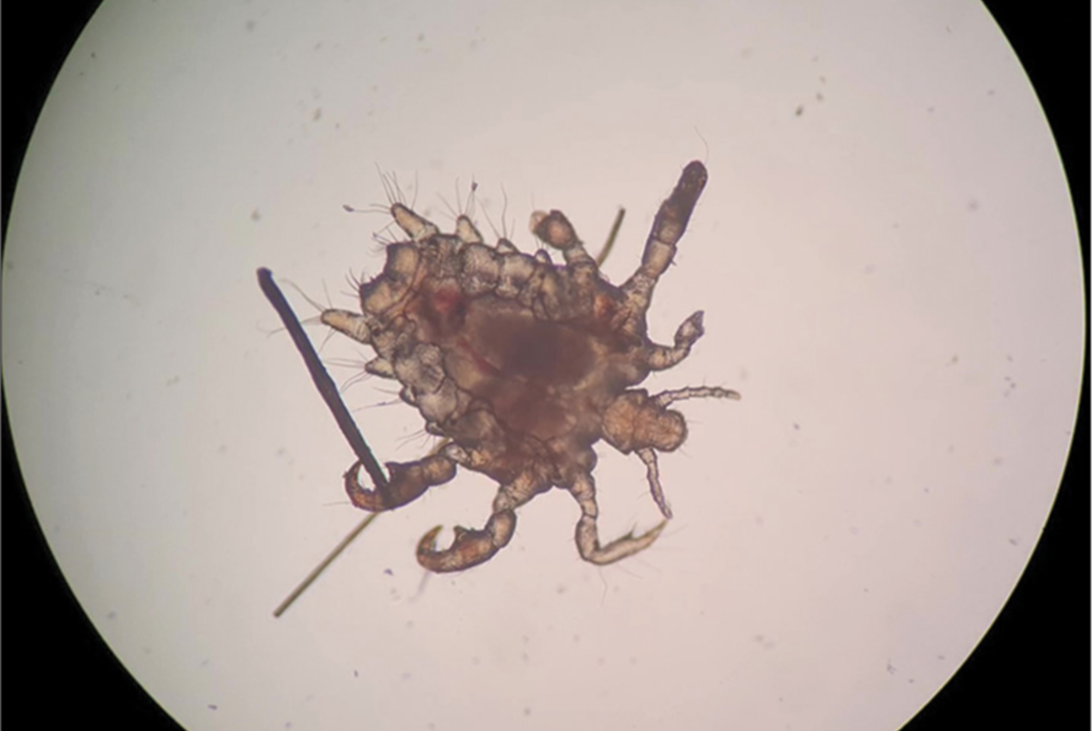 Can I Get Pubic Lice During Sex?