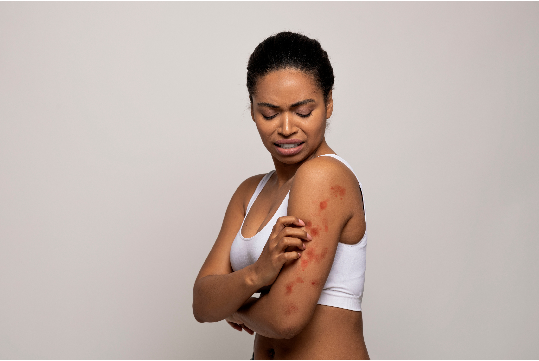 Is Scabies an STI?