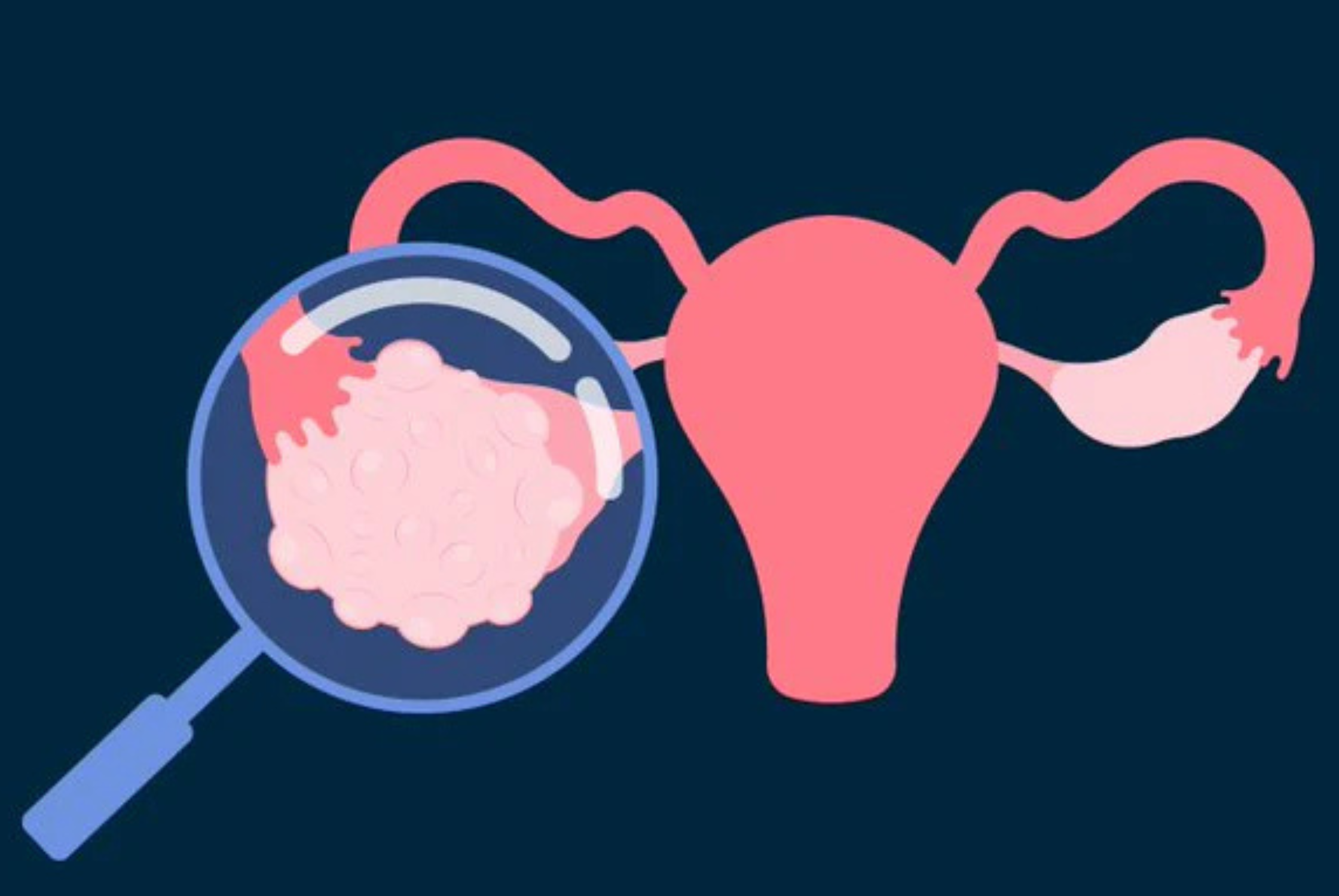 What Is Hyperovulation?