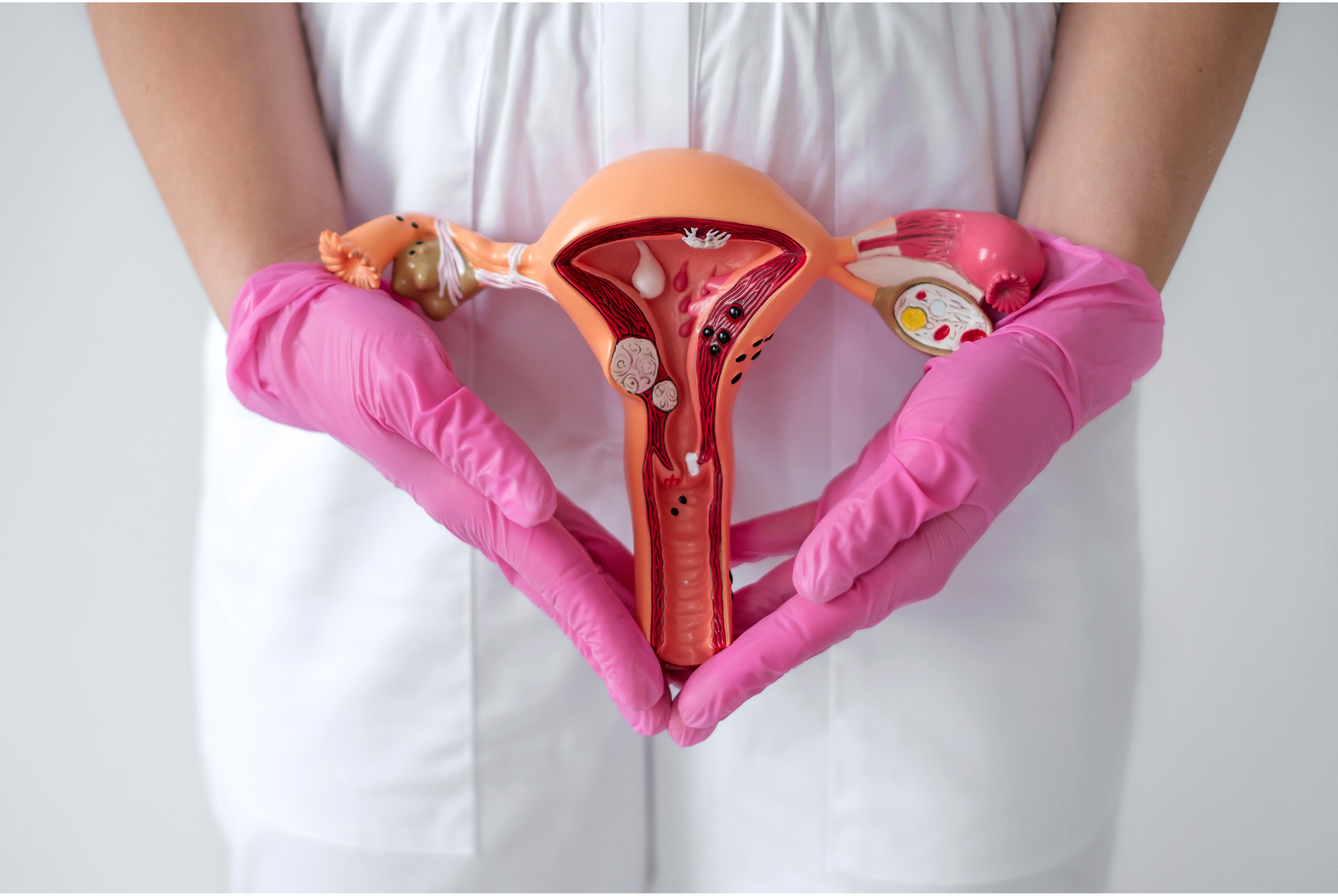 What’s the Difference Between PCOS and Endometriosis?